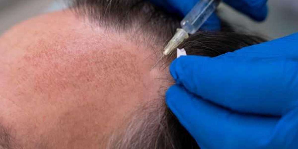 How Non-Surgical Hair Restoration Can Transform Your Look